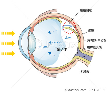 視網膜剝離示意圖 141081190