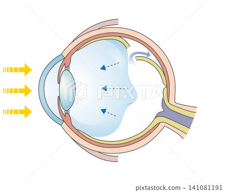 Diagram illustrating retinal detachment Diagram illustrating retinal detachment 141081191