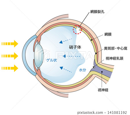 視網膜撕裂示意圖。 視網膜撕裂示意圖。 141081192