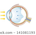 Diagram illustrating a retinal tear. 141081193