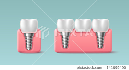 3D tooth implant icon with screw fixture 141099400