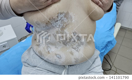 Professional removal of papillomas and moles with electrocoagulation procedure in dermatology clinic. overweight European woman on the surgical table. moles papillomas neoplasms on the body 141101790