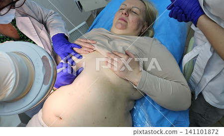 Professional removal of papillomas and moles with electrocoagulation procedure in dermatology clinic. overweight European woman on the surgical table. moles papillomas neoplasms on the body 141101872