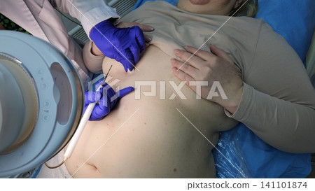 Professional removal of papillomas and moles with electrocoagulation procedure in dermatology clinic. overweight European woman on the surgical table. moles papillomas neoplasms on the body Professional removal of papillomas and moles with electrocoagulation procedure in dermatology clinic. overweight European woman on the surgical table. moles papillomas neoplasms on the body 141101874
