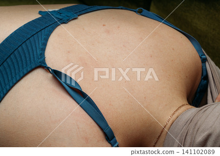 Macro close-up of a benign nevus or papilloma on Caucasian skin. Small benign mole on the upper back of a Caucasian woman. Macro close-up of a benign nevus or papilloma on Caucasian skin. Small benign mole on the upper back of a Caucasian woman. 141102089