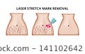 Laser stretch mark removal treatment showing before, during and after 141102642
