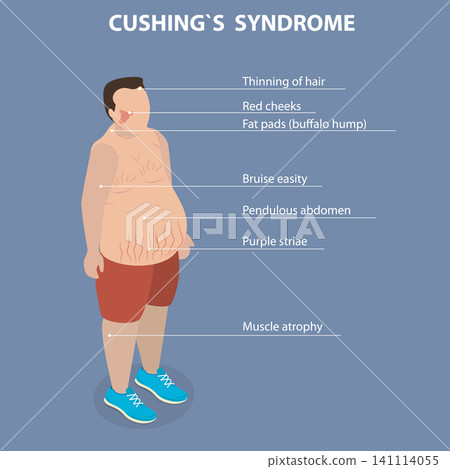 3D Isometric Flat Vector Illustration of Cushing Syndrome, Overproduction Of Cortisol By Body Results In CushingS Syndrome Leading To Various Health Issues. 141114055