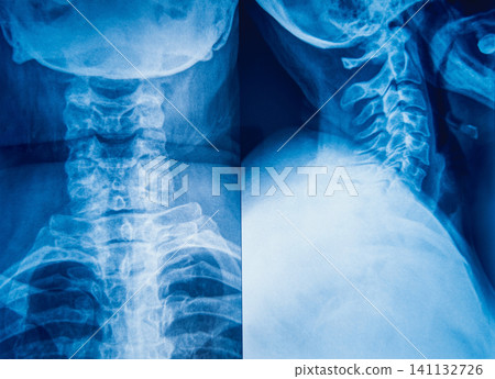 X-Ray Image of human neck for a medical diagnosis. X-Ray Image of human neck for a medical diagnosis. 141132726