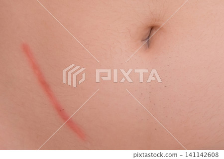 Body abdomen skin scar after removal of appendicitis surgery consequences of surgery, close-up Body abdomen skin scar after removal of appendicitis surgery consequences of surgery, close-up 141142608