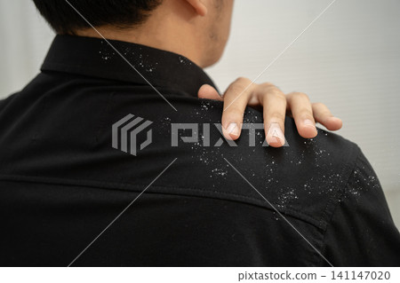 Man with dandruff on shirt at shoulder. Man with dandruff on shirt at shoulder. 141147020