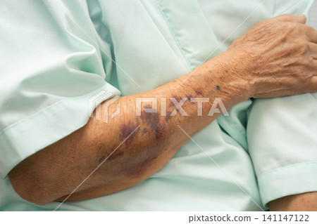 Ecchymosis, elderly bleeding on her arm after taking aspirin. Ecchymosis, elderly bleeding on her arm after taking aspirin. 141147122