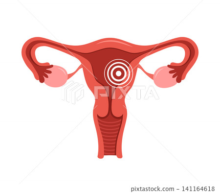 Uterus pain. Human internal organ disease. Reproductive system medical diagnosis and treatment. Vector illustration in flat style Uterus pain. Human internal organ disease. Reproductive system medical diagnosis and treatment. Vector illustration in flat style 141164618