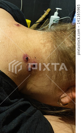 Woman's neck displaying red and healing bite marks from hirudotherapy, illustrating the concept of alternative medicine and natural treatment for health and wellness. Woman's neck displaying red and healing bite marks from hirudotherapy, illustrating the concept of alternative medicine and natural treatment for health and wellness. 141165965