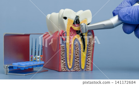 Endodontics concept. Educational anatomical model of a tooth with deep caries and pulpitis treatment demonstration. Endodontics concept. Educational anatomical model of a tooth with deep caries and pulpitis treatment demonstration. 141172684