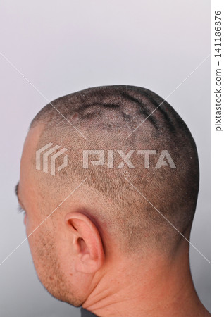 scalp representing skin disorder and chronic irritation, scalp representing skin disorder and chronic irritation, 141186876