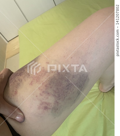 Large birthmark Large birthmark 141207802