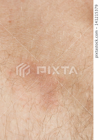Allergic spots on the patients body after vaccination, side effects. Allergic spots on the patients body after vaccination, side effects. 141215379