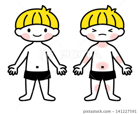 [Medical/Childcare] Illustration of a boy with eczema (atopic dermatitis) 141227591