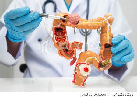 Colorectal cancer, doctor holding intestine colon human anatomy model. 141235232
