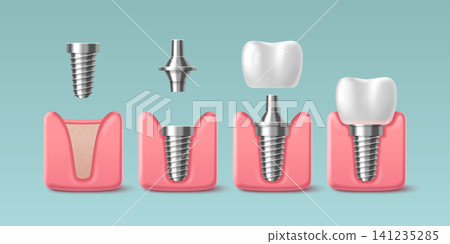 3D tooth implant installation set 3D tooth implant installation set 141235285