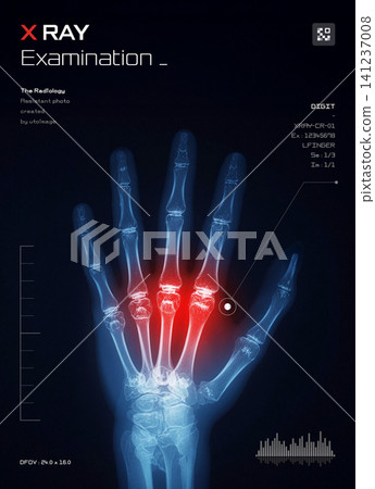X-ray diagnostic image of finger arthritis X-ray diagnostic image of finger arthritis 141237008