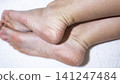 Dry skin on the feet, woman heel 141247484