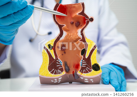 Asian doctor with rectum and hemorrhoid human anatomy model at hospital, inflamed vascular structure. Asian doctor with rectum and hemorrhoid human anatomy model at hospital, inflamed vascular structure. 141260256