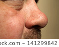 person's nose covered in small acne 141299842