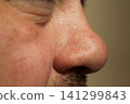 person's nose covered in small acne 141299843