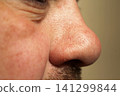 person's nose covered in small acne 141299844