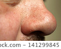 person's nose covered in small acne 141299845