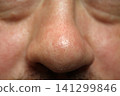 person's nose covered in small acne 141299846