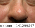 person's nose covered in small acne 141299847