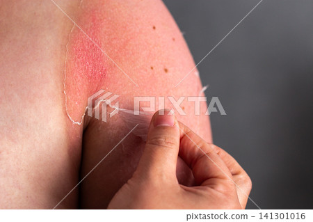 Woman removing old peeling skin after sunburn. UV damage and unprotected tanning consequences visible. Burn recovery process Woman removing old peeling skin after sunburn. UV damage and unprotected tanning consequences visible. Burn recovery process 141301016