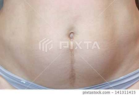 Vertical cesarean section scar on woman abdomen nine years after surgery Vertical cesarean section scar on woman abdomen nine years after surgery 141311415