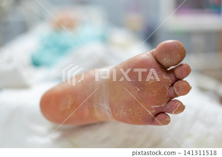 Closeup of dry cracked peeling foot skin showing dehydration callus dermatology condition Healthcare concept selective focus clinical setting 141311518