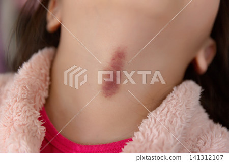 a close up of purple bruises on the neck of a child . a close up of purple bruises on the neck of a child . 141312107