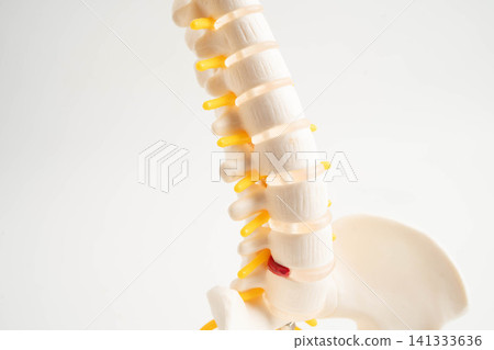 Spinal nerve and bone, Lumbar spine displaced herniated disc fragment, Model for treatment medical in the orthopedic department. Spinal nerve and bone, Lumbar spine displaced herniated disc fragment, Model for treatment medical in the orthopedic department. 141333636