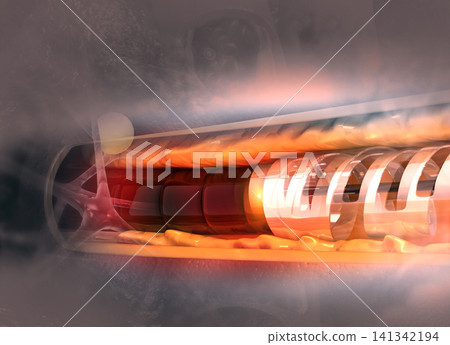 Human heart angioplasty 141342194