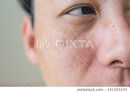 一位40多歲男子的臉部瑕疵 一位40多歲男子的臉部瑕疵 141343243