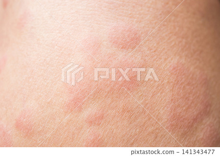 Skin allergy rash dermatitis texture close up background Skin allergy rash dermatitis texture close up background 141343477
