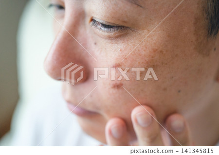 一位40多歲男子的臉部瑕疵 一位40多歲男子的臉部瑕疵 141345815