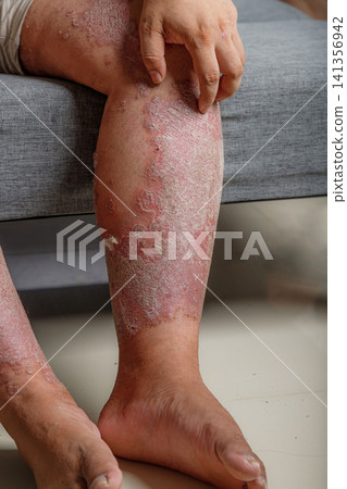 Close-up of inflamed dry scaly skin on a human leg, A chronic skin condition with redness, irritation, and flaky texture for healthcare and dermatology Close-up of inflamed dry scaly skin on a human leg, A chronic skin condition with redness, irritation, and flaky texture for healthcare and dermatology 141356942