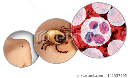 Anaplasmosis Bacterial Infection 141357395