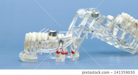 Panoramic web banner of a transparent dental jaw model showing tooth roots, metal crown, and root apex infections on a blue background. Panoramic web banner of a transparent dental jaw model showing tooth roots, metal crown, and root apex infections on a blue background. 141359030