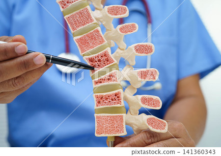 Doctor holding osteoporosis in back bone model for treatment medical in orthopedic department. Doctor holding osteoporosis in back bone model for treatment medical in orthopedic department. 141360343