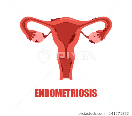 Endometriosis diseases. Medical check up. Vector illustration in flat style Endometriosis diseases. Medical check up. Vector illustration in flat style 141371862