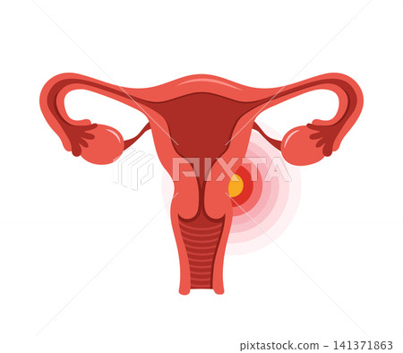 Uterus pain. Human internal organ disease. Reproductive system medical diagnosis and treatment. Vector illustration in flat style Uterus pain. Human internal organ disease. Reproductive system medical diagnosis and treatment. Vector illustration in flat style 141371863