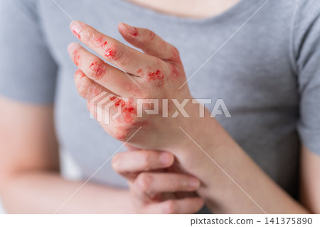 雙手皸裂的女子(特效化妝) 雙手皸裂的女子(特效化妝) 141375890