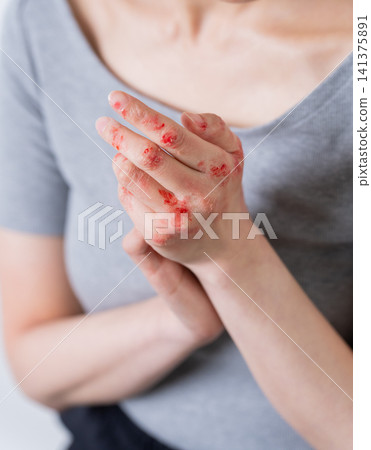 雙手皸裂的女子(特效化妝) 雙手皸裂的女子(特效化妝) 141375891